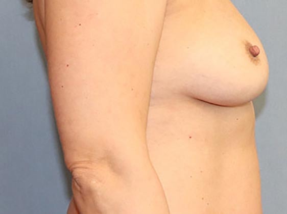 Breast Revision & Asymmetry Before And After Photo