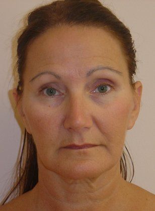 Facelift Before And After Photo