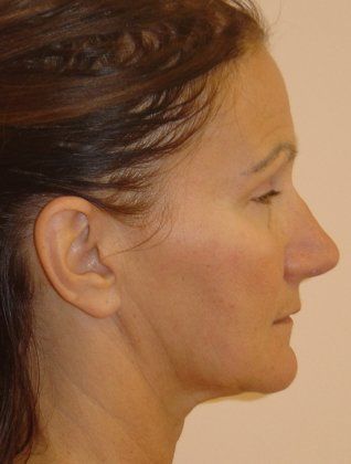 Facelift Before And After Photo