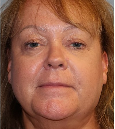 FaceTite Before And After Patient 1