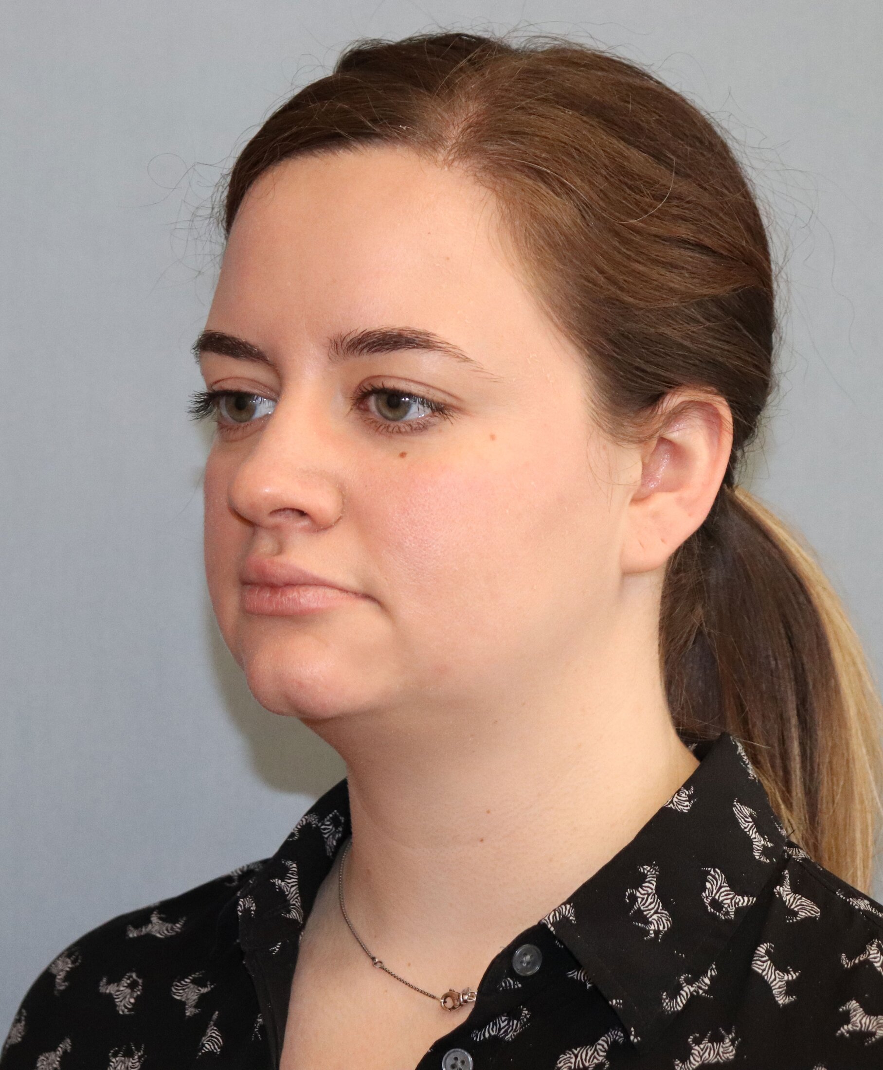 FaceTite Before & After Image