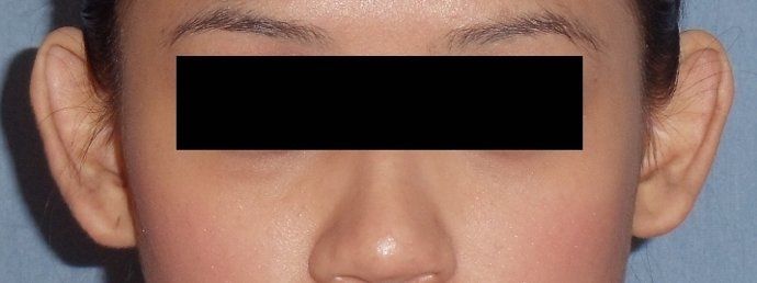 Otoplasty Before And After Photo