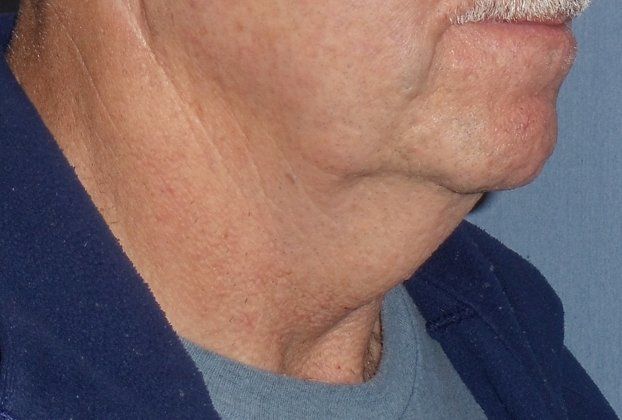 SmartLipo Neck Before And After Photo