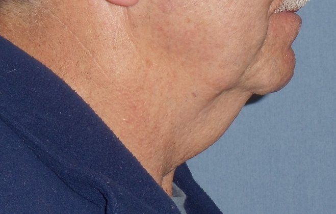 SmartLipo Neck Before And After Photo