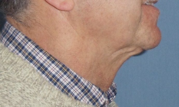 SmartLipo Neck Before And After Photo