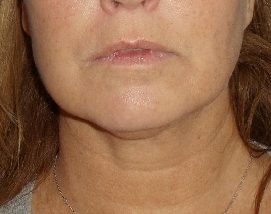 SmartLipo Neck Before And After Photo