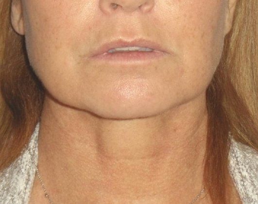 SmartLipo Neck Before And After Photo