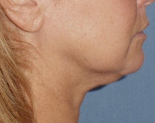 SmartLipo Neck Before And After Photo