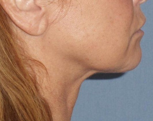 SmartLipo Neck Before And After Photo