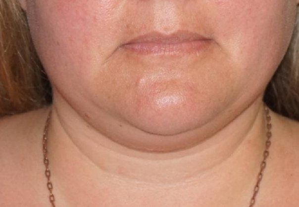 SmartLipo Neck Before And After Photo