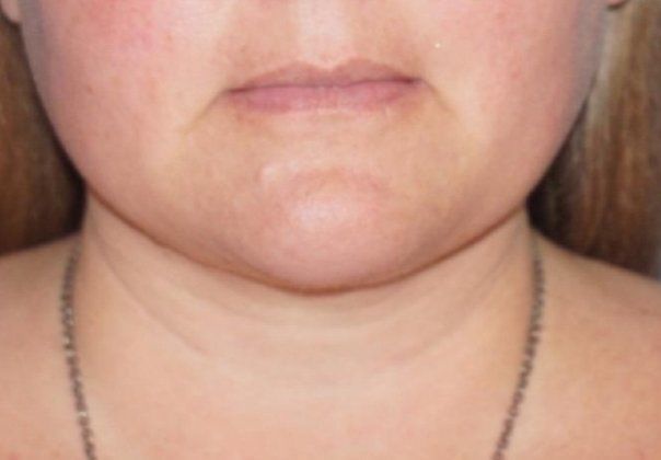 Smartlipo Laser Facial Sculpting Before And After Patient 3