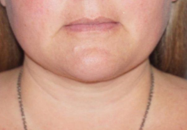 SmartLipo Neck Before And After Photo