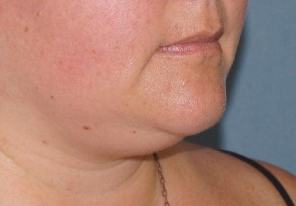 SmartLipo Neck Before And After Photo