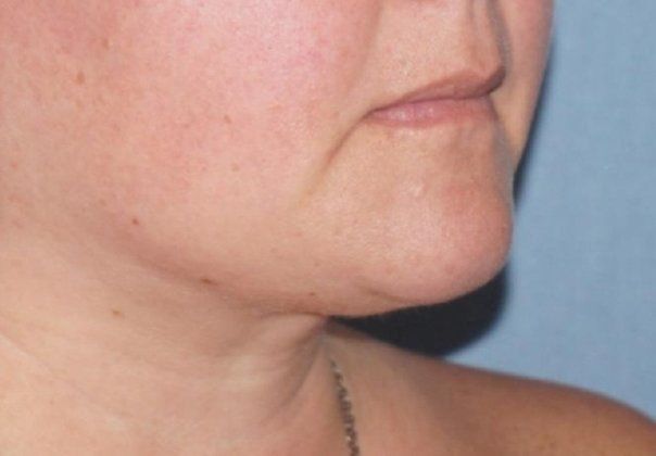 SmartLipo Neck Before And After Photo