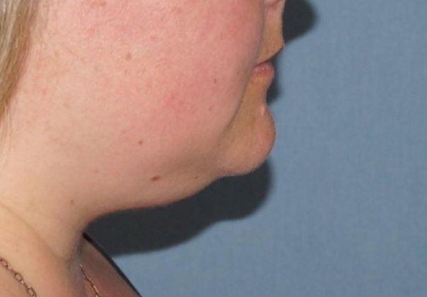 SmartLipo Neck Before And After Photo