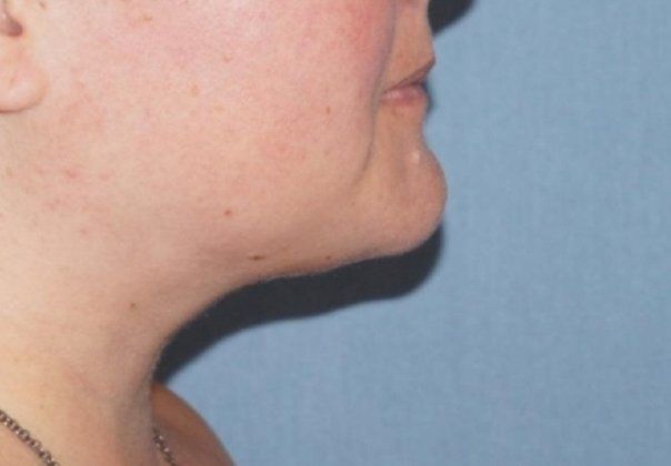 SmartLipo Neck Before And After Photo