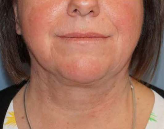 SmartLipo Neck Before And After Photo