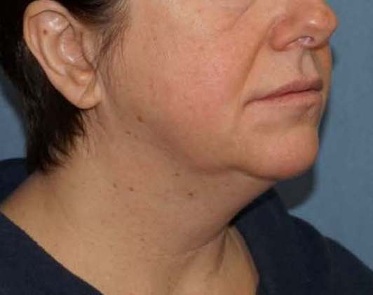 SmartLipo Neck Before And After Photo