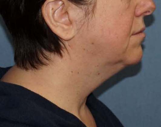 SmartLipo Neck Before And After Photo