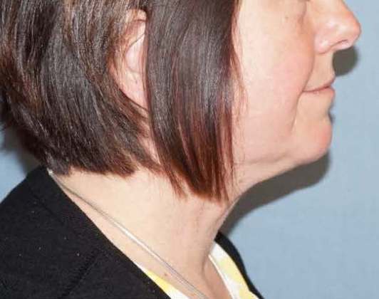 SmartLipo Neck Before And After Photo