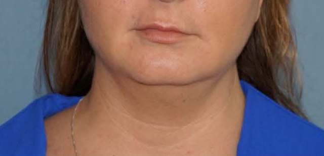 SmartLipo Neck Before And After Photo