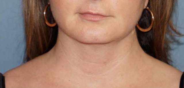 Smartlipo Laser Facial Sculpting Before And After Patient 5