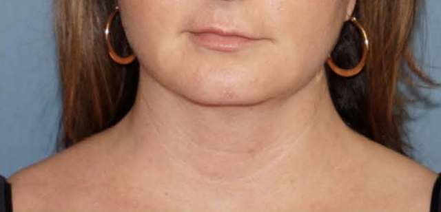 SmartLipo Neck Before And After Photo