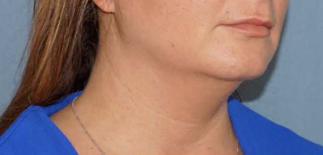 SmartLipo Neck Before And After Photo