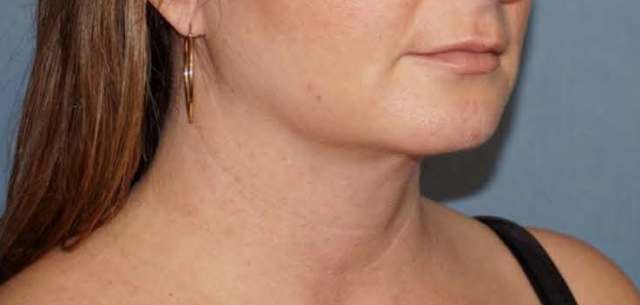 SmartLipo Neck Before And After Photo