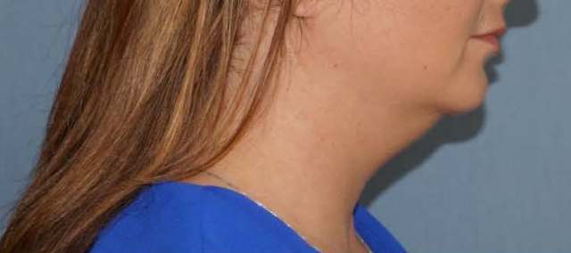 SmartLipo Neck Before And After Photo