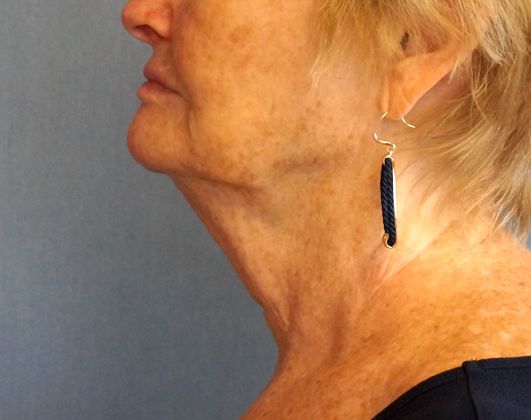 SmartLipo Neck Before And After Photo