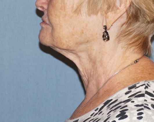 SmartLipo Neck Before And After Photo