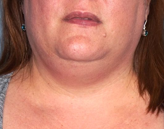 SmartLipo Neck Before And After Photo