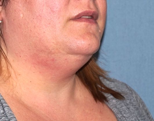 SmartLipo Neck Before And After Photo