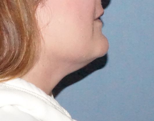 SmartLipo Neck Before And After Photo