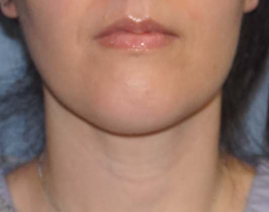 SmartLipo Neck Before And After Photo