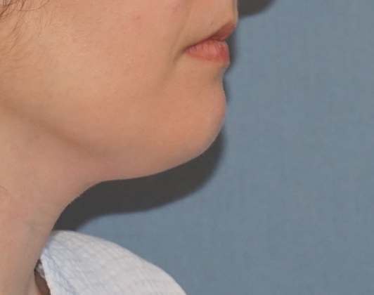 SmartLipo Neck Before And After Photo