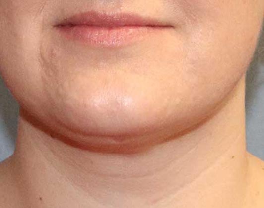 SmartLipo Neck Before And After Photo