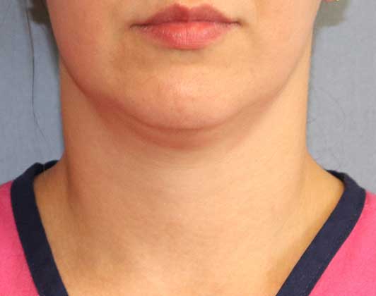 SmartLipo Neck Before And After Photo