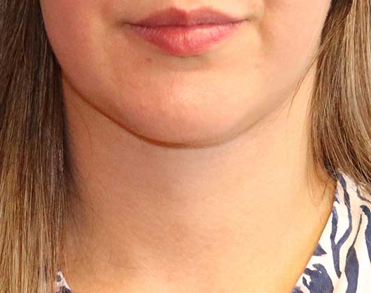 SmartLipo Neck Before And After Photo