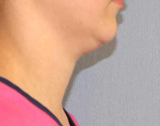 SmartLipo Neck Before And After Photo