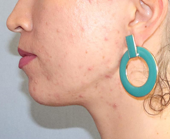 Botox & Fillers Before & After Image
