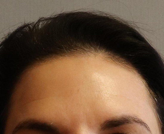 Botox & Fillers Before And After Patient 2