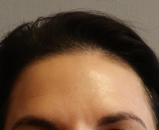 Botox & Fillers Before And After Patient 3