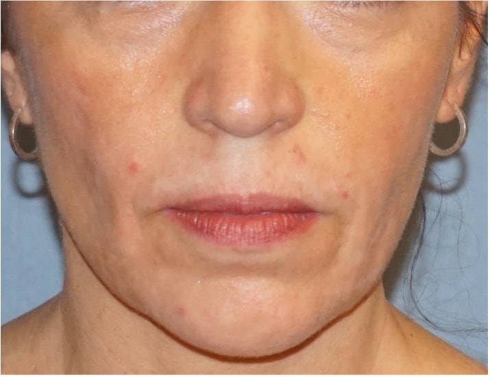 Botox & Fillers Before And After Photo
