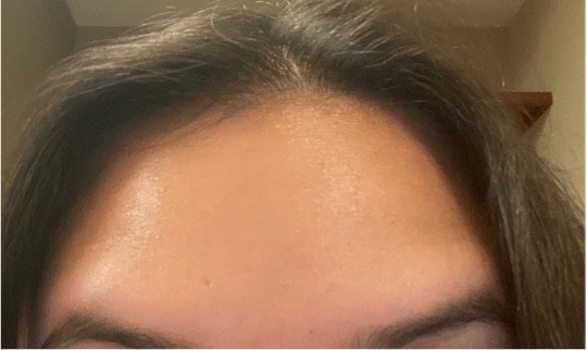 Boston Microneedling After Picture