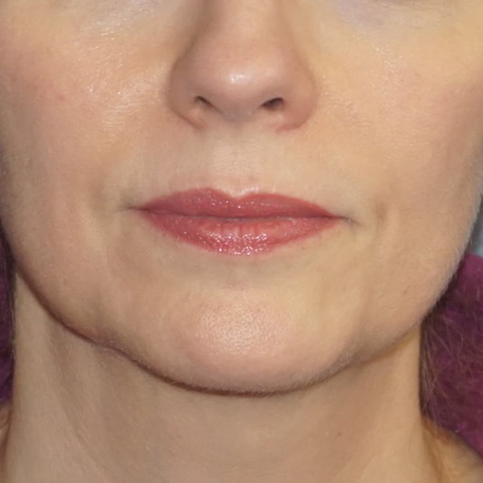 Botox & Fillers Before And After Patient 6