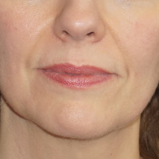 Botox & Fillers Before And After Photo