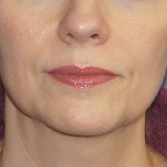 Botox & Fillers Before And After Photo