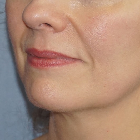 Botox & Fillers Before And After Photo